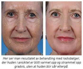 Rordam vanlig